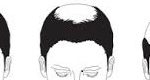 androgentic alopecia men
