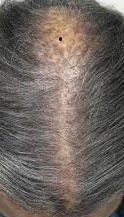 Central Centrifugal Cicatrical Alopecia (CCCA)
